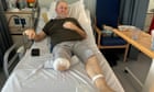 ‘It looked like corned beef’: life inside a Welsh amputation ward – as diabetes gets worse