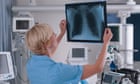 Allow more people in UK with lung cancer symptoms to self-refer for tests, say experts