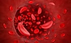 ‘Groundbreaking’ potential cure for sickle cell in England approved for NHS use